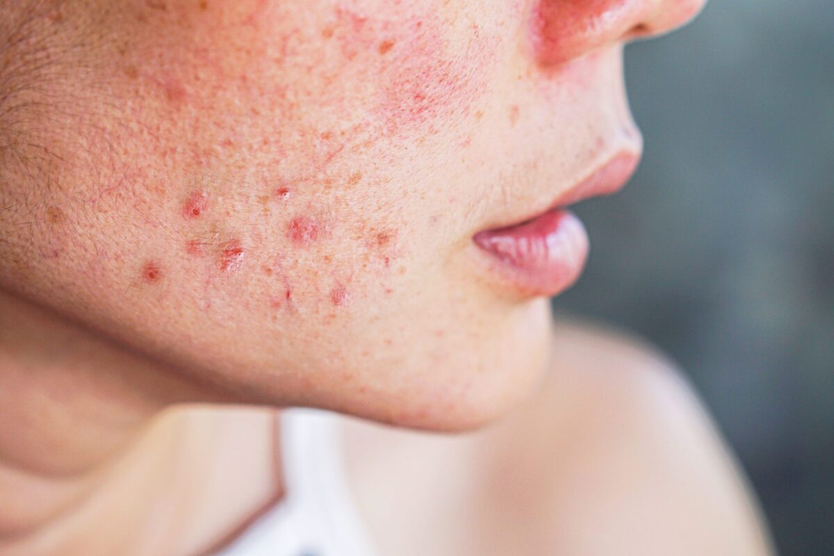 Close-up of skin breakouts on a person’s face